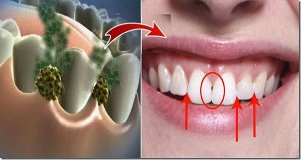 eliminate-bad-breath-in-5-minutes-this-remedy-will-destroy-all-the-bacteria-that-cause-bad-breath