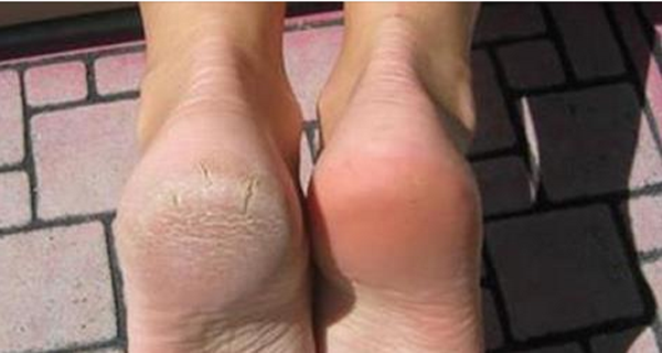 you-have-dry-and-cracked-heels-try-baking-soda