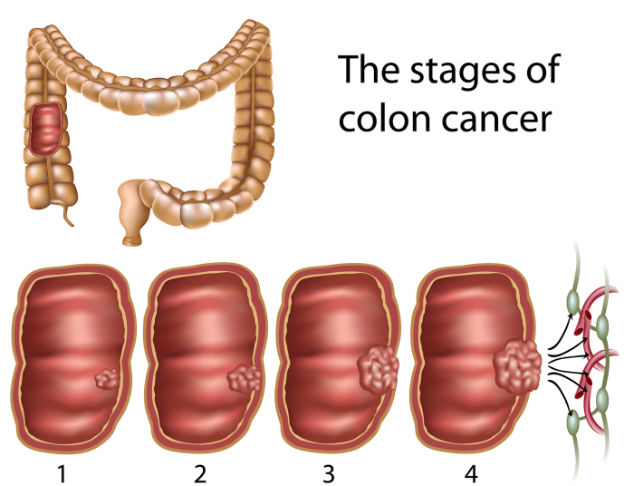 coloncancerstages-1457632733n8gk4-700x536