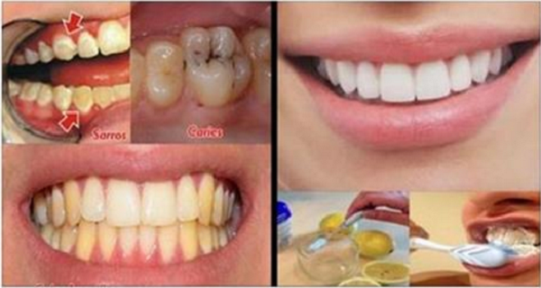 say-goodbye-to-caries-tartar-and-yellow-color-of-your-teeth-with-the-help-of-this-remedy