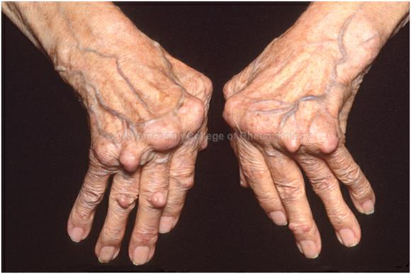 revmatoidnyj-artrit-foto-2