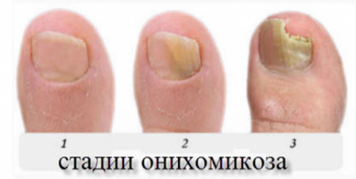 Лечение грибка ногтей йодом фото до и после