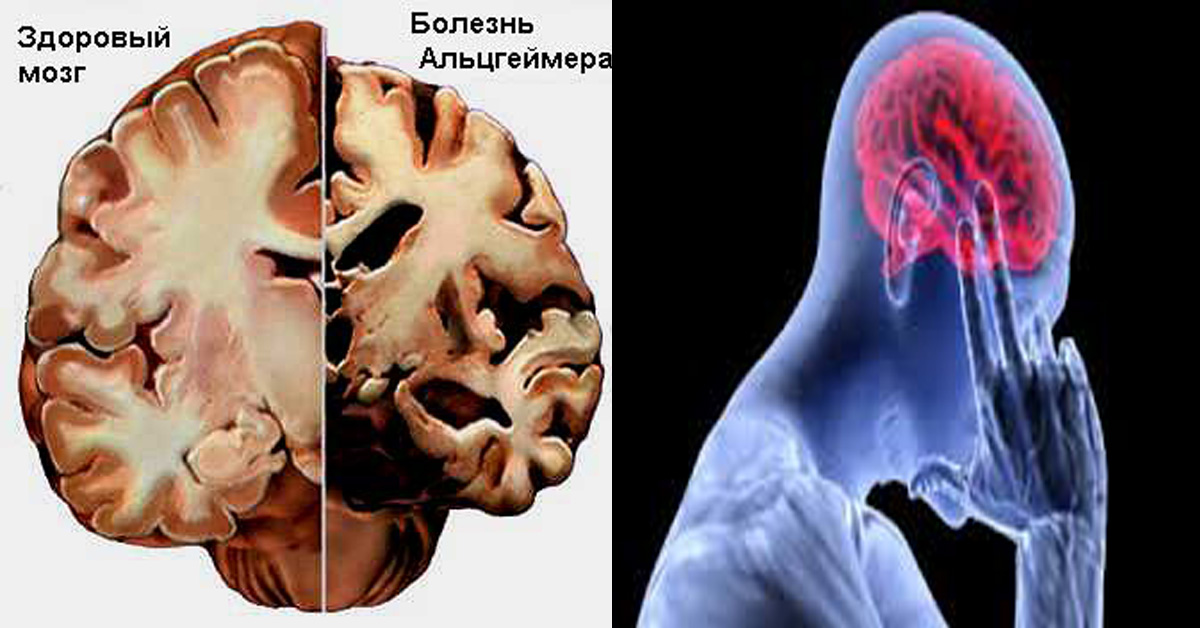 Возрастные изменения мозга. Болезнь Альцгеймера деменция. Мозг болезньальцгецмера. Мозг здорового человека и Альцгеймера.