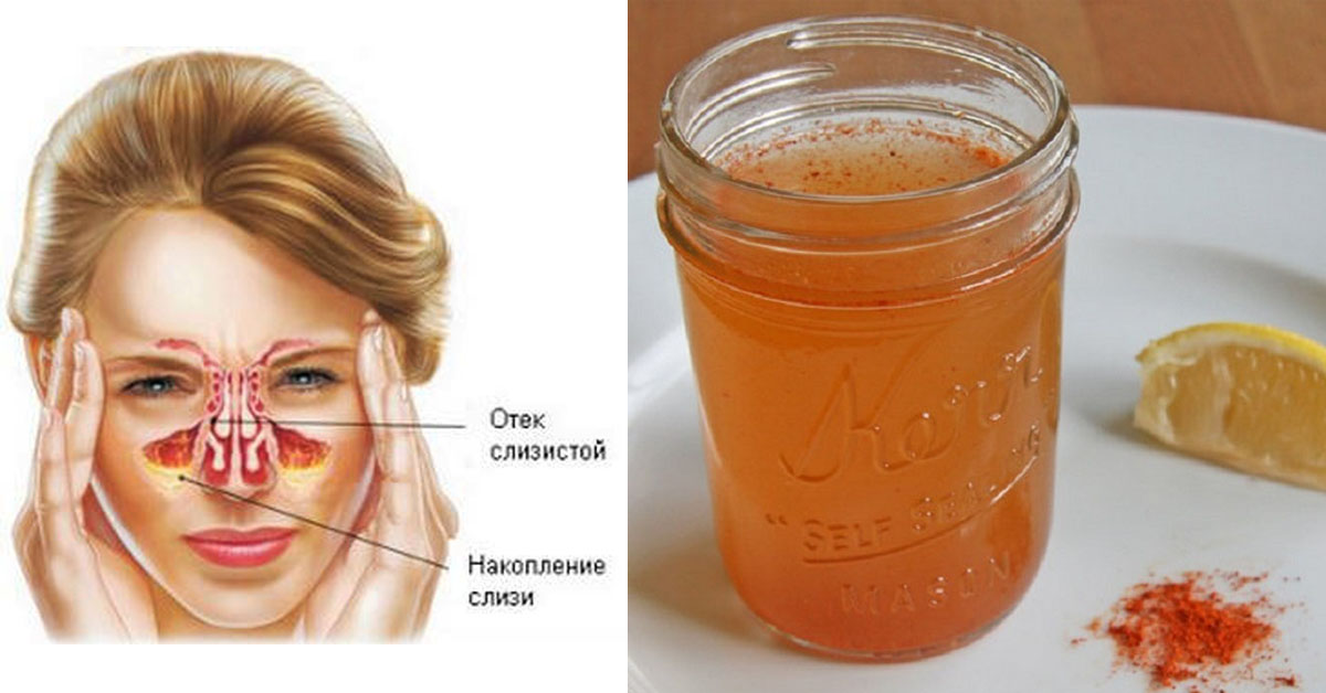 Мед сода масло нос. Мед от гайморита. Гайморит мед и сода. Мед с содой от гайморита. Мед от гайморита сода и растительное.