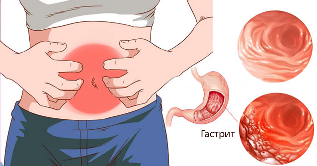 Tratamiento gastritis cronica