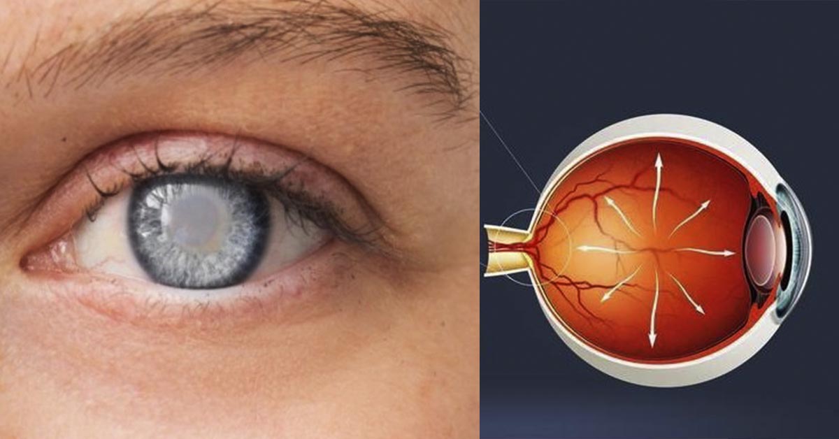 Глазное давление при катаракте